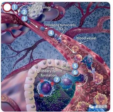 癌癥轉移機制 癌癥轉移機制
